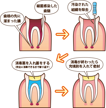 根管治療の手順