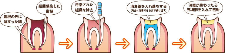 根管治療の手順