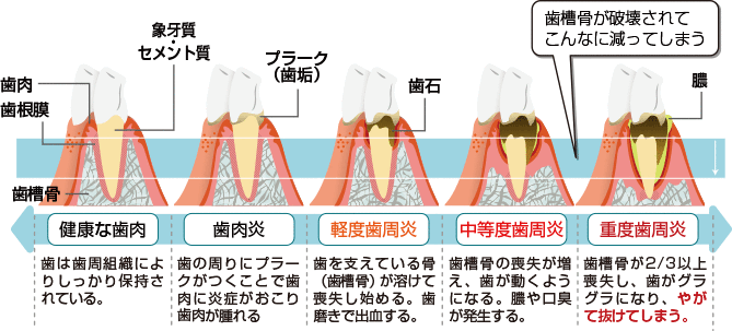 歯周病の進行